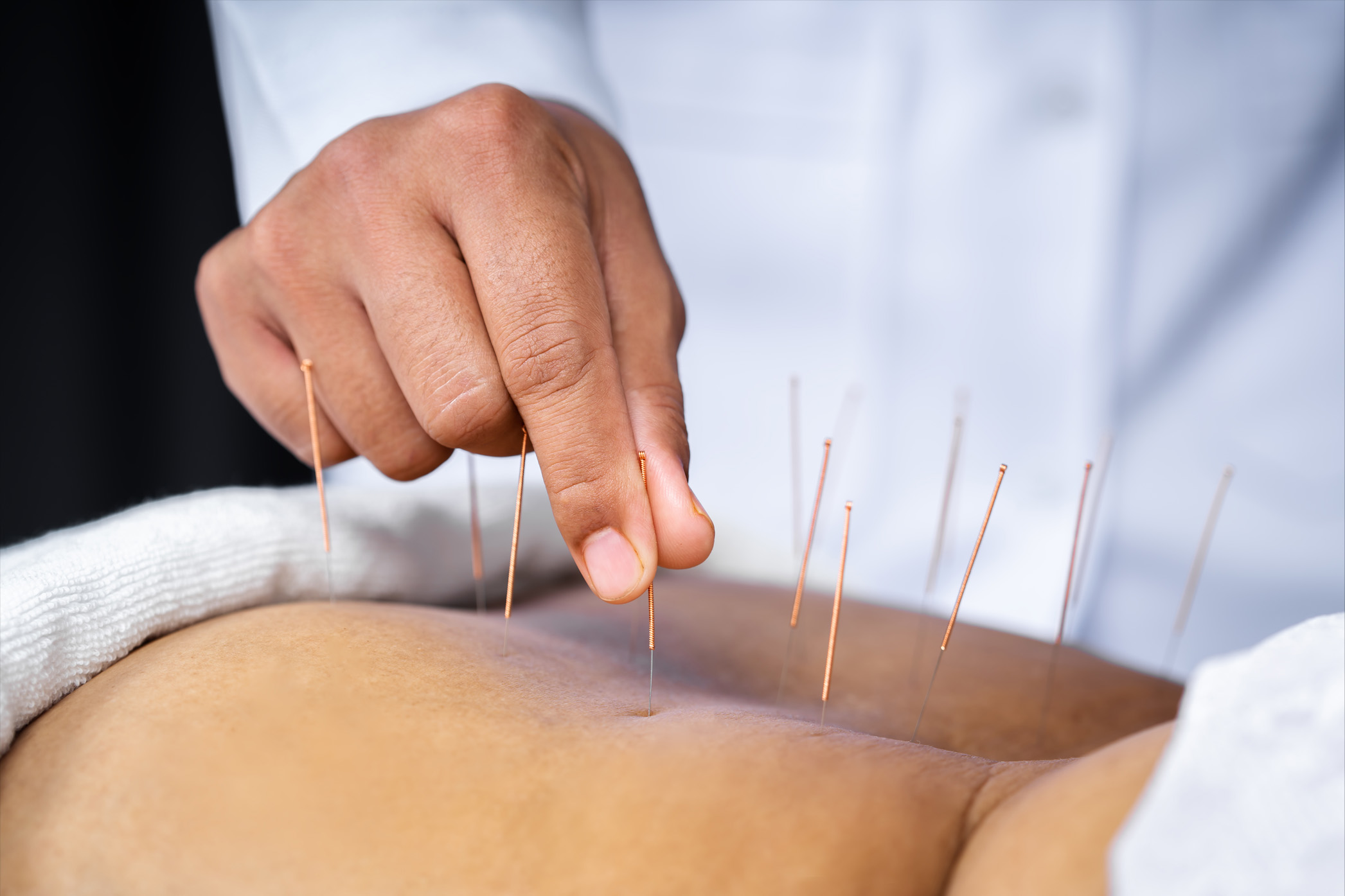 Close-up of senior female back with steel needles during procedu
